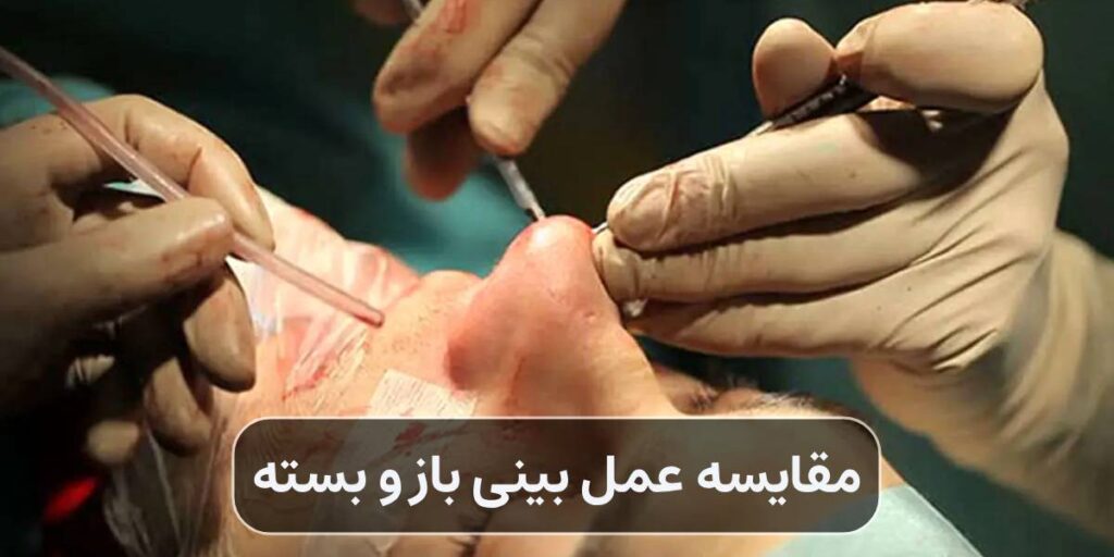 مقایسه عمل بینی باز و بسته