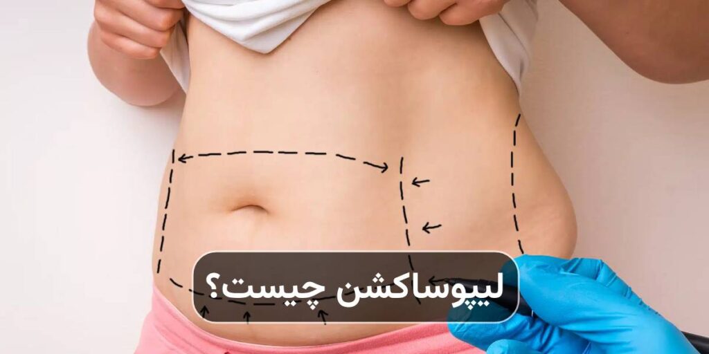 لیپوساکشن چیست