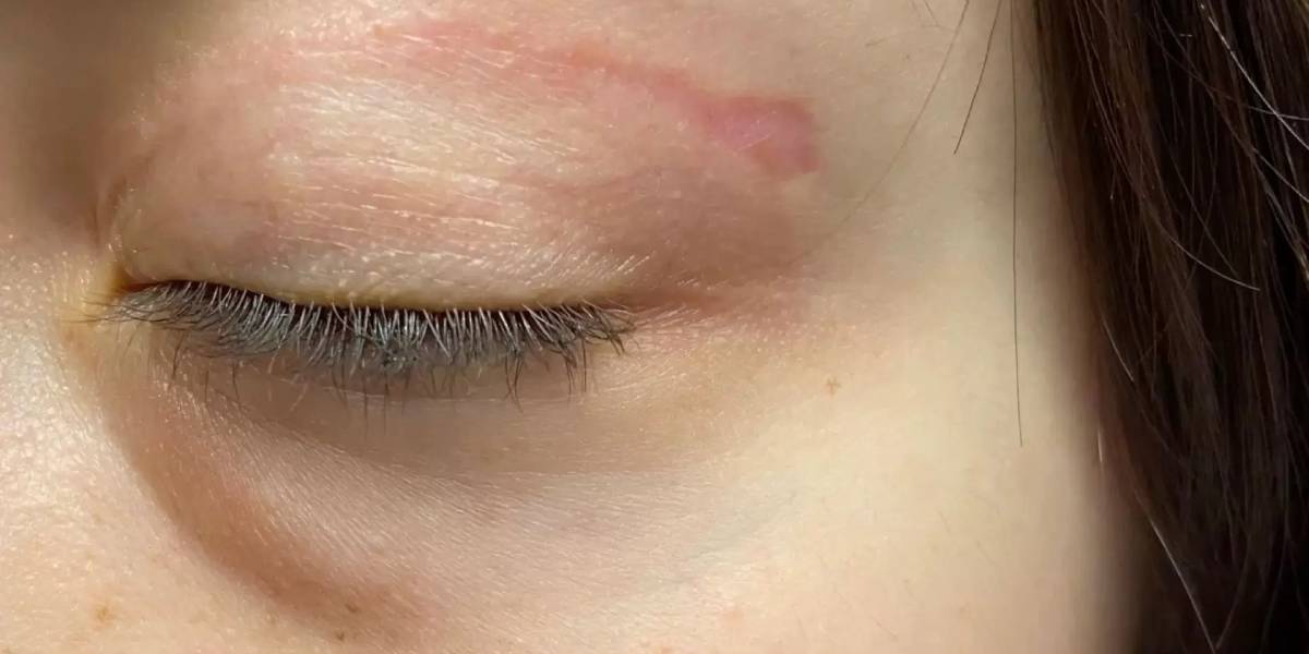 بهترین سن برای عمل بلفاروپلاستی