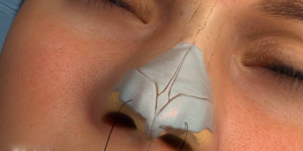 رینوپلاستی بینی گوشتی 